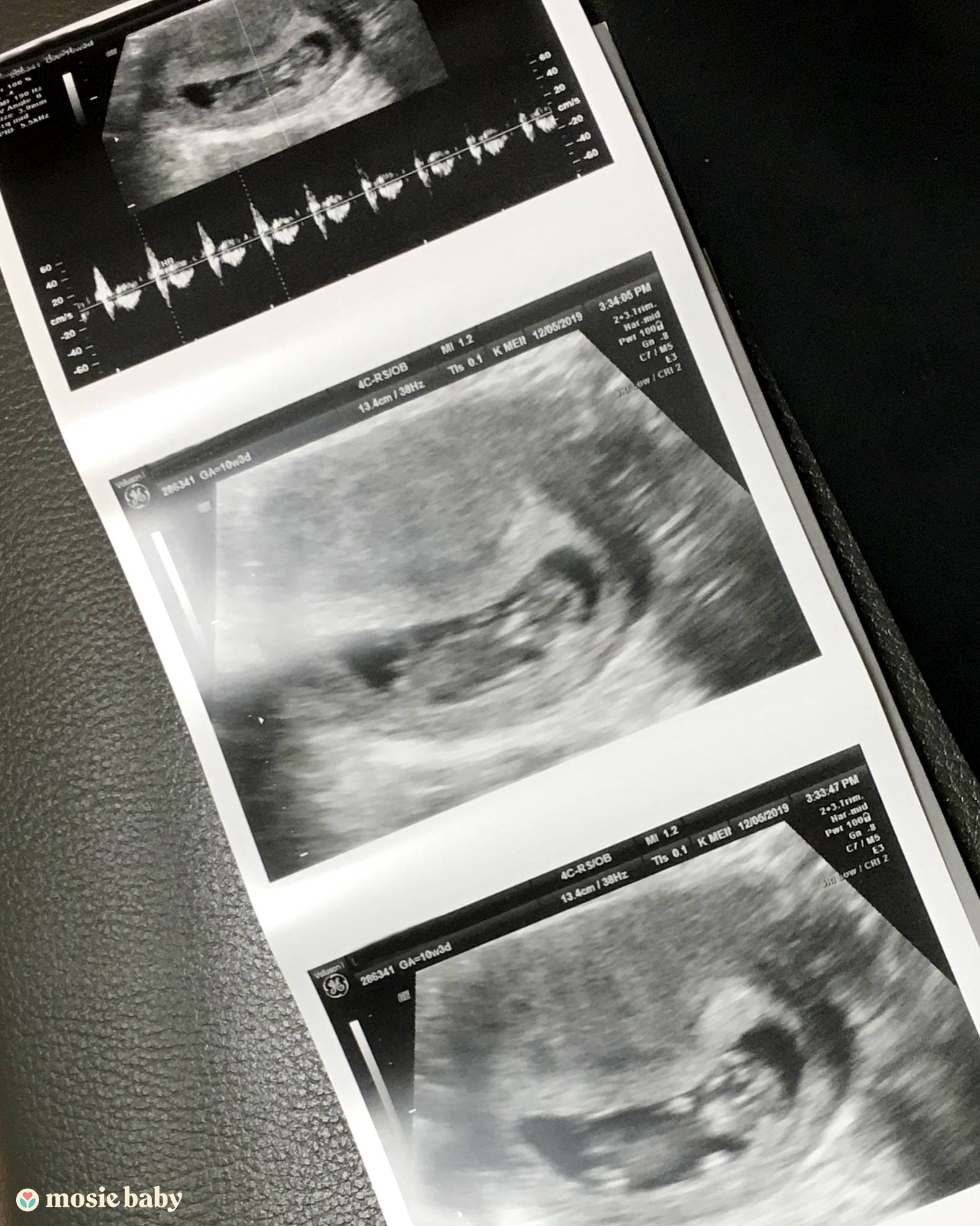 A sonogram of a baby